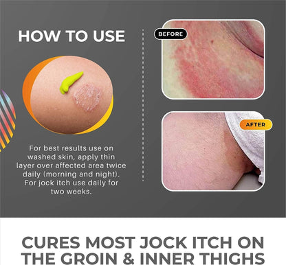 Jock Itch Treatment | Antifungal Cream | 50ml